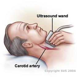 Carotid Artery Ultrasound