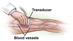 This image is a graphic of a leg, blood vessels are visible in the leg. An arm and hand is seen performing a duplex ultrasound test on the leg, a transducer is being held against the blood vessels on the leg.