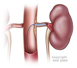 An upclose look at an angioplasty