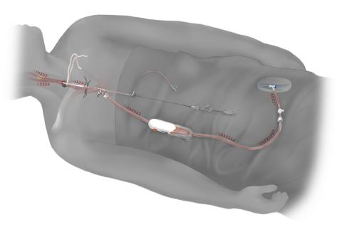 Overview of the TCAR procedure