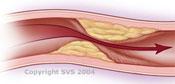 an image of blood trying to flow through a very blocked artery due to PAD