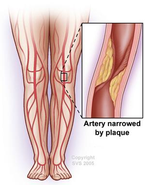 Arteries in log, with detail on narrowed artery